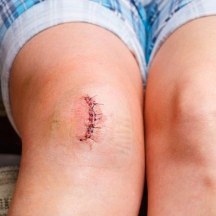 Hegkezelés térden - Floss, FDM, köpöly, tape, tréning